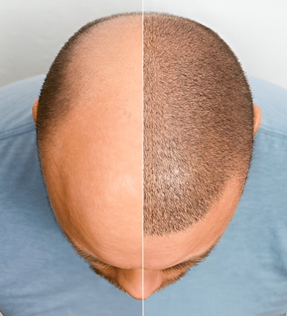 Hair transplant