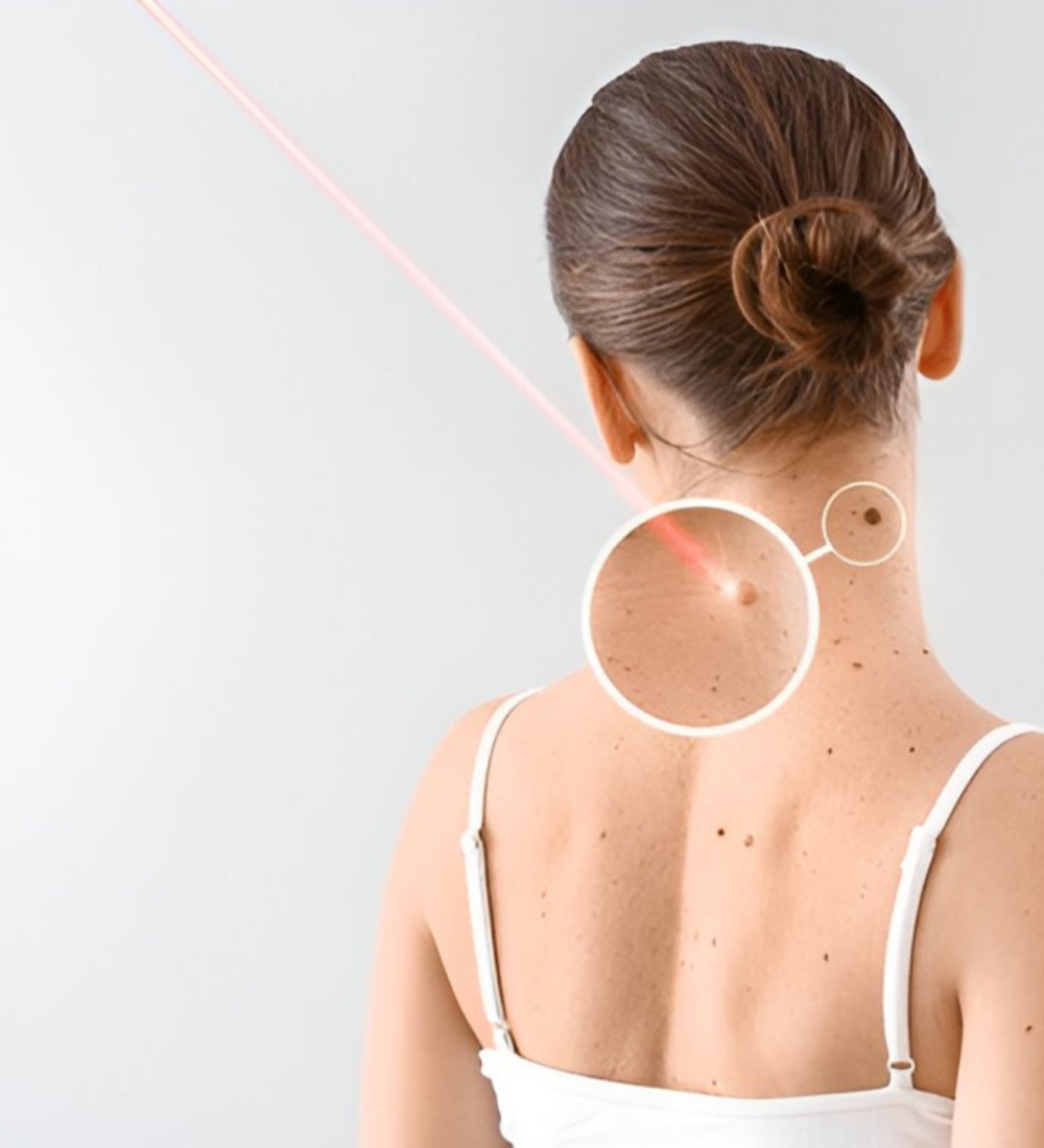 Mole & Wart Removal